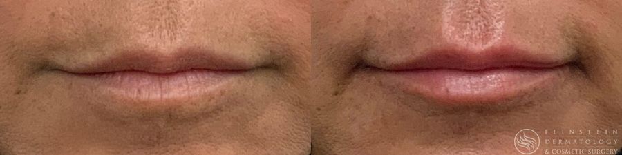 Dermal Fillers - Case 12299