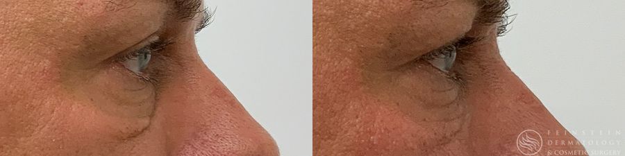 Dermal Fillers - Case 12298