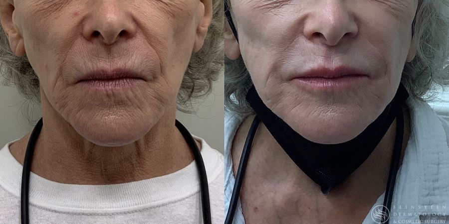 Dermal Fillers - Case 12292