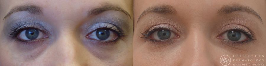 Dermal Fillers - Case 12267