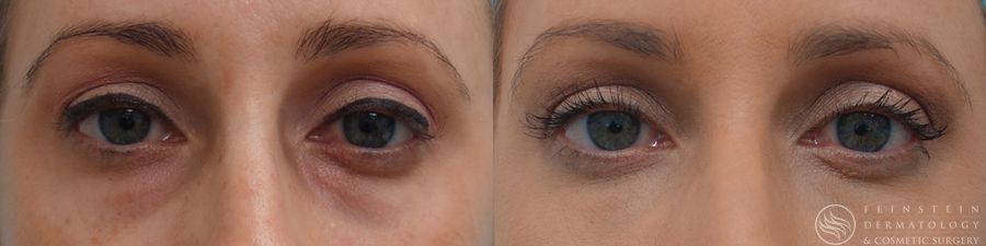 Dermal Fillers - Case 12268