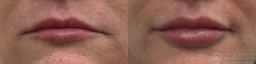 Dermal Fillers - Case 12300