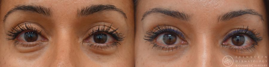 Dermal Fillers - Case 12301