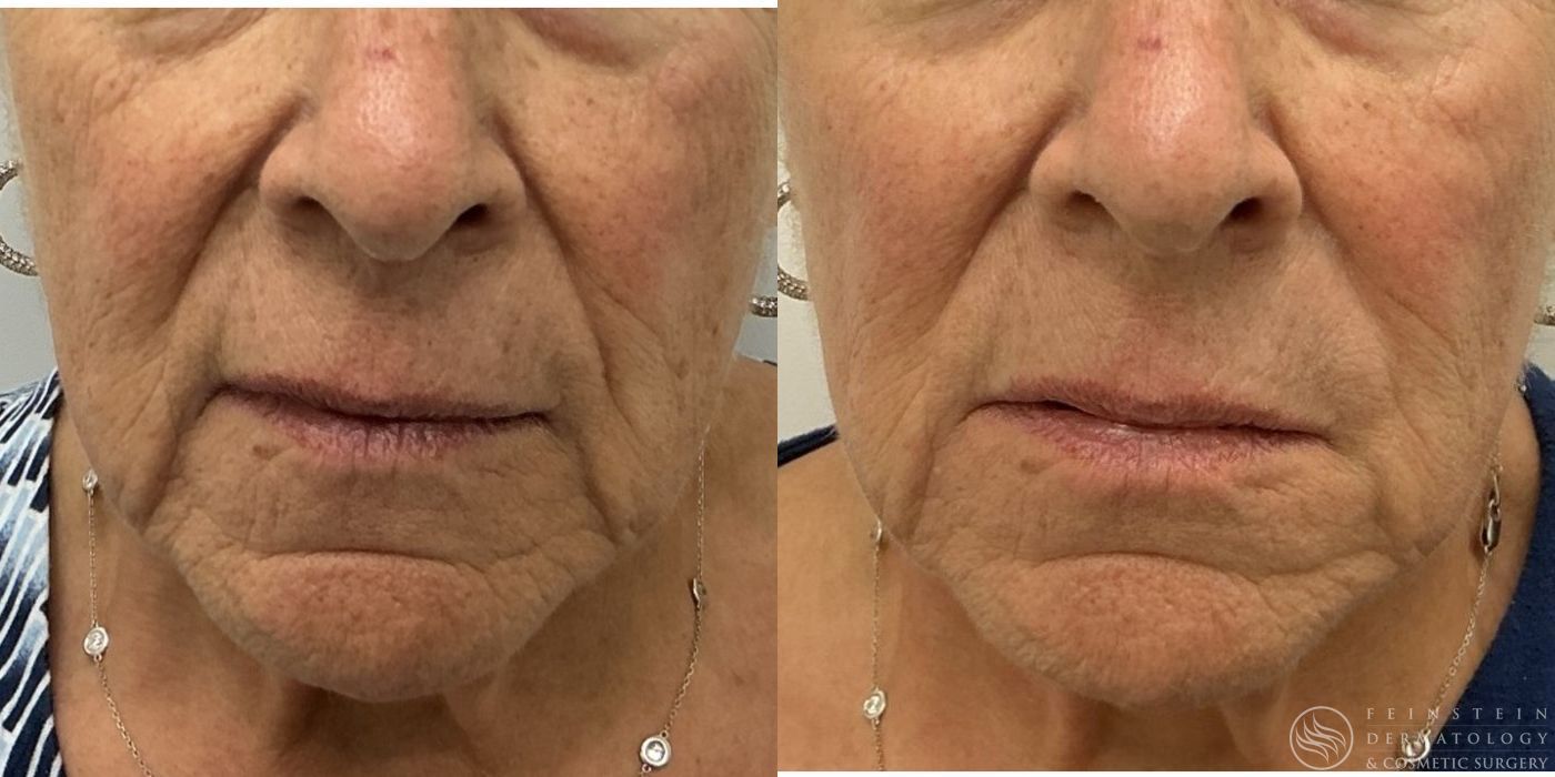 Dermal Fillers - Case 12384