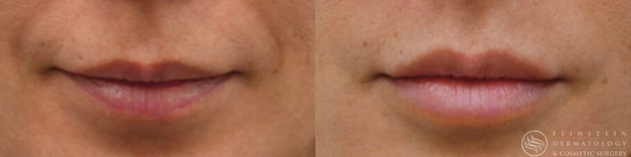Dermal Fillers - Case 12280