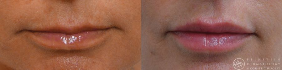 Dermal Fillers - Case 12285