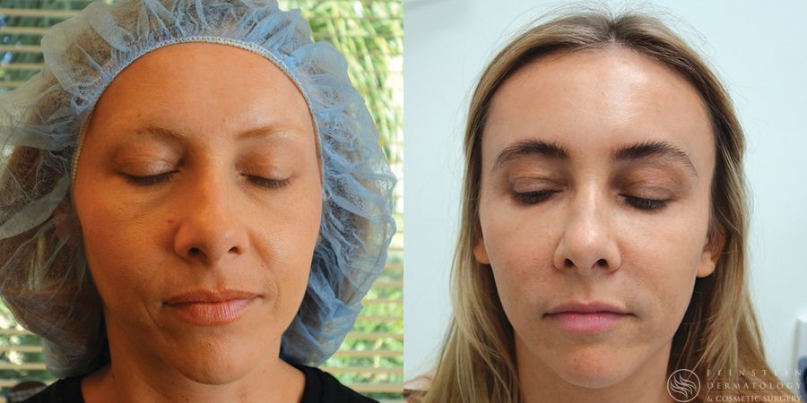 Dermal Fillers - Case 12302