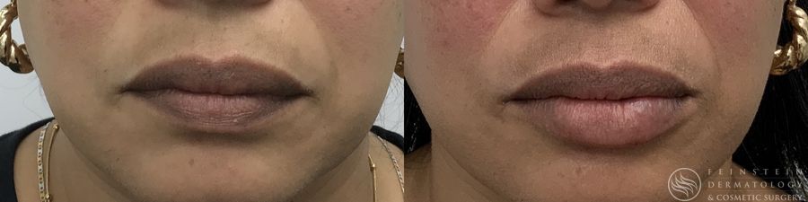 Dermal Fillers - Case 12295