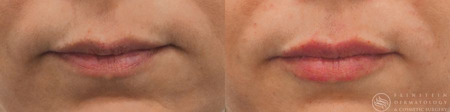 Dermal Fillers - Case 12264