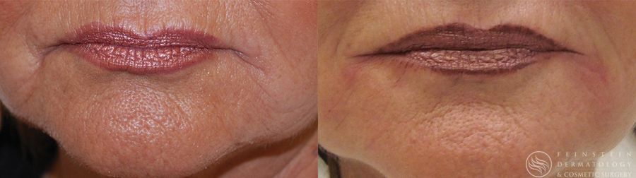 Dermal Fillers - Case 12279