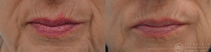 Dermal Fillers - Case 12269