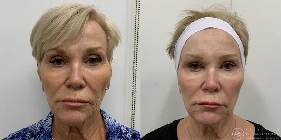 Dermal Fillers - Case 12290