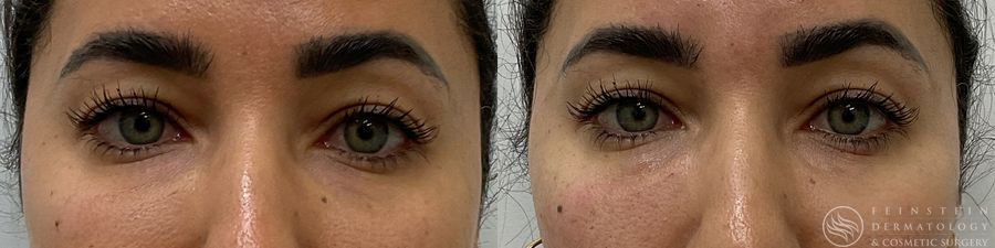 Dermal Fillers - Case 12288