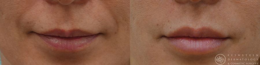 Dermal Fillers - Case 12271
