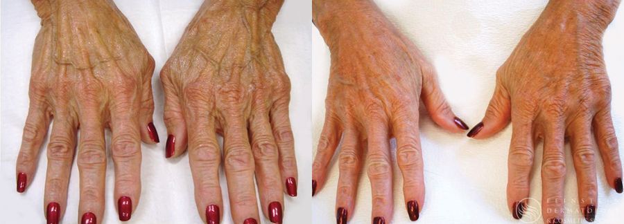 Dermal Fillers - Case 12284