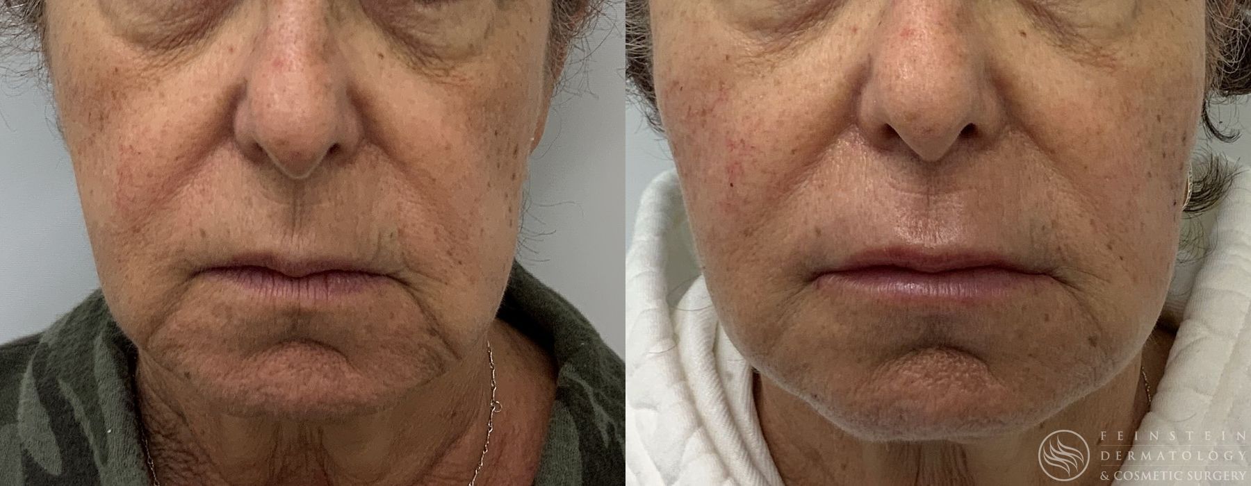 Before and after Dermal Fillers case 33069