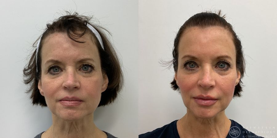 Dermal Fillers - Case 12291