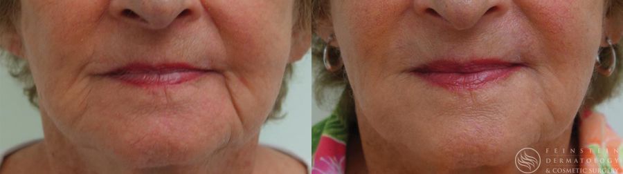 Dermal Fillers - Case 12275