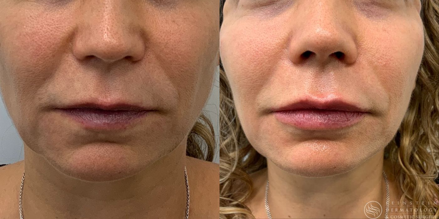 Dermal Fillers - Case 12253