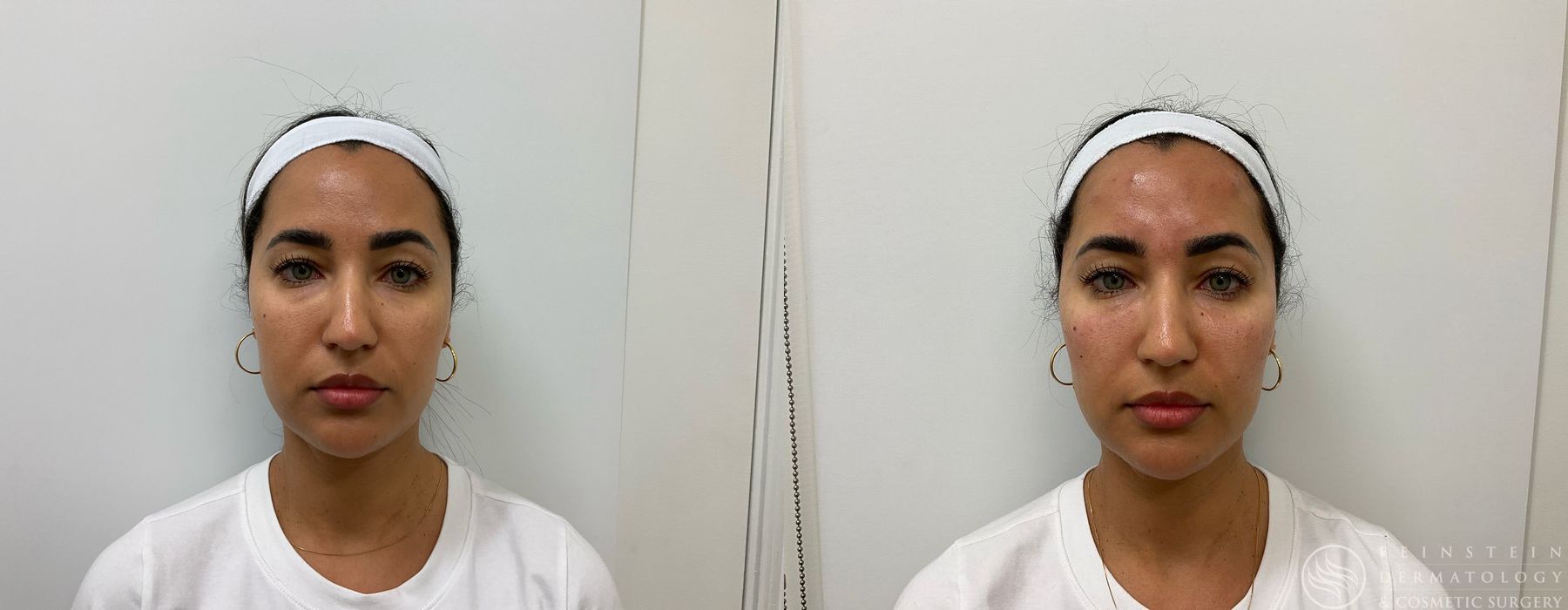 Dermal Fillers - Case 12258