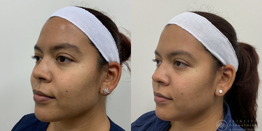 Dermal Fillers - Case 12289
