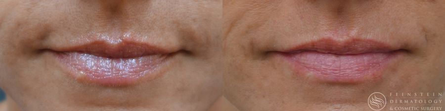 Dermal Fillers - Case 12286
