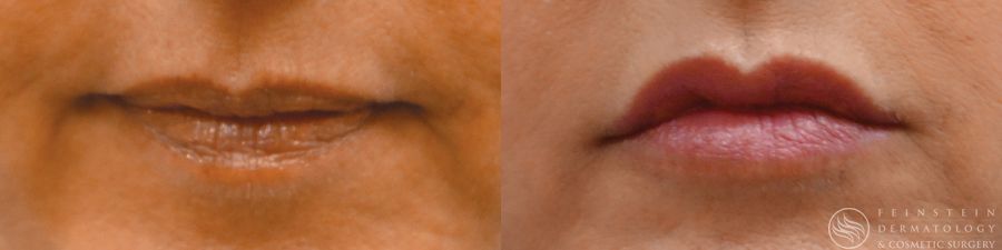 Dermal Fillers - Case 12265
