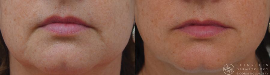 Dermal Fillers - Case 12277