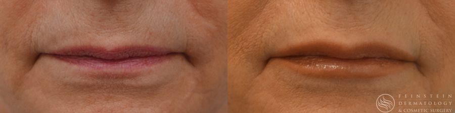 Dermal Fillers - Case 12263