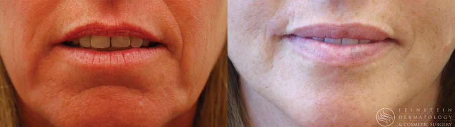 Dermal Fillers - Case 12276