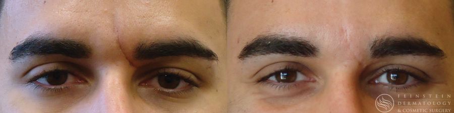 Dermal Fillers - Case 12261