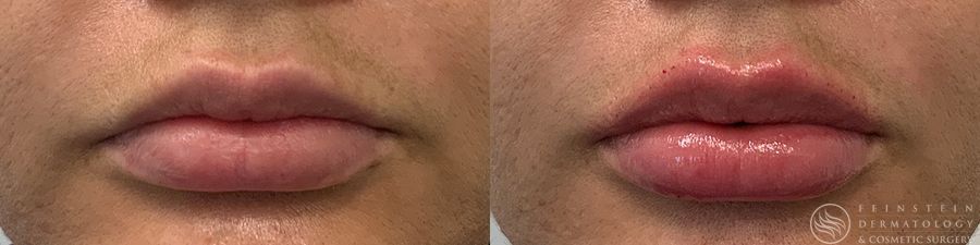 Dermal Fillers - Case 12270