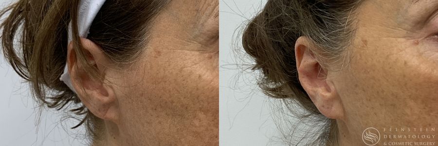 Earlobe Repair - Case 12211