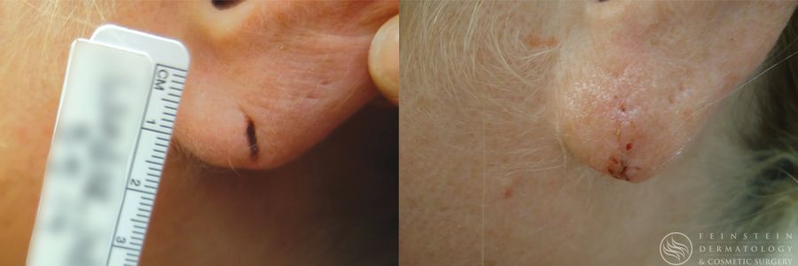 Earlobe Repair - Case 12213