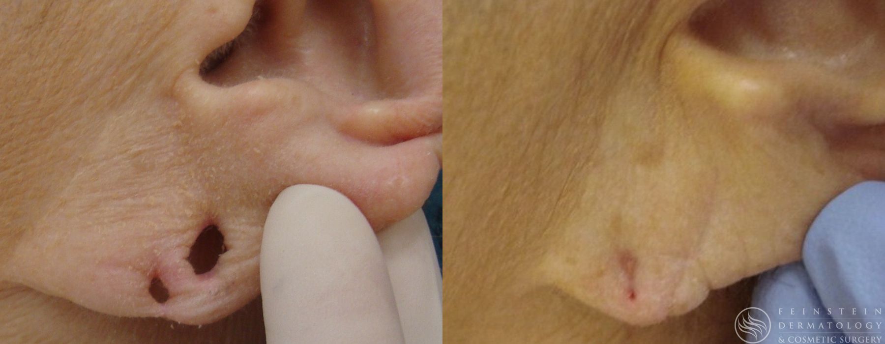 Earlobe Repair - Case 12210