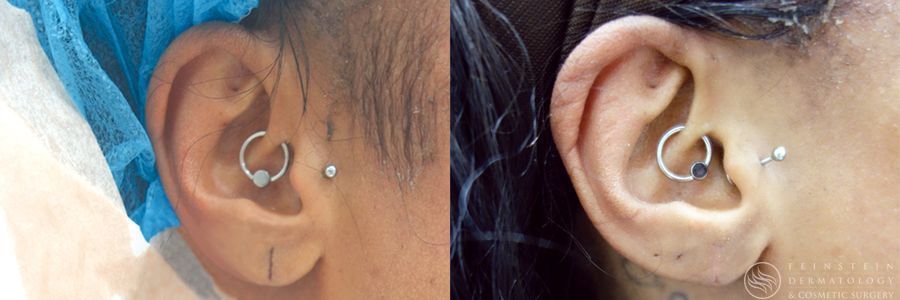 Earlobe Repair - Case 12215