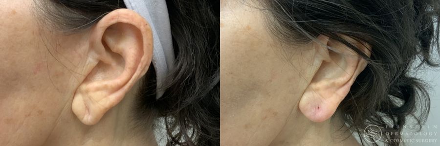 Earlobe Repair - Thumbnail 2