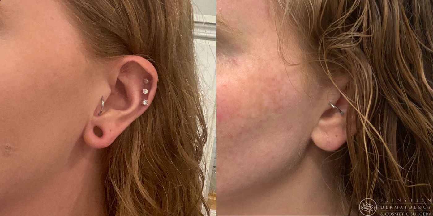 Earlobe Repair - Case 12209