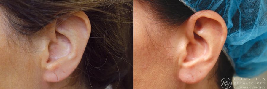 Earlobe Repair - Case 12214