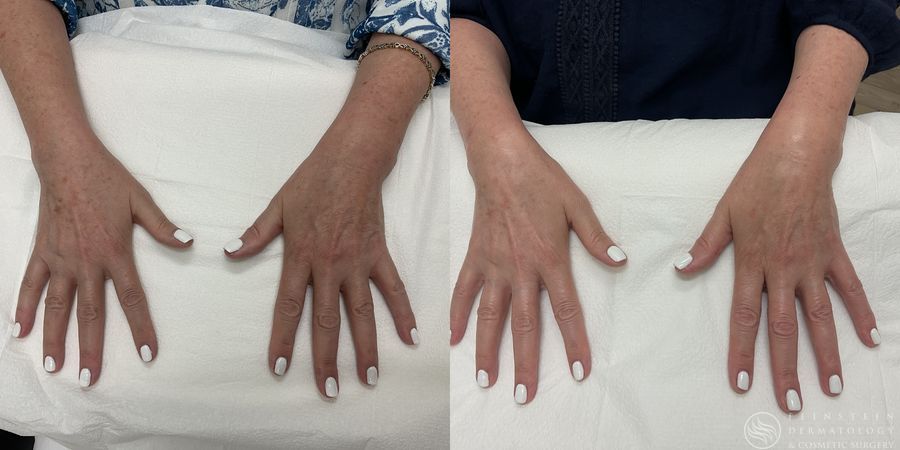 Forever Young® BBL - Case 12318