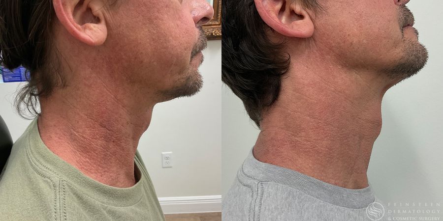 Before photo - Angle 2