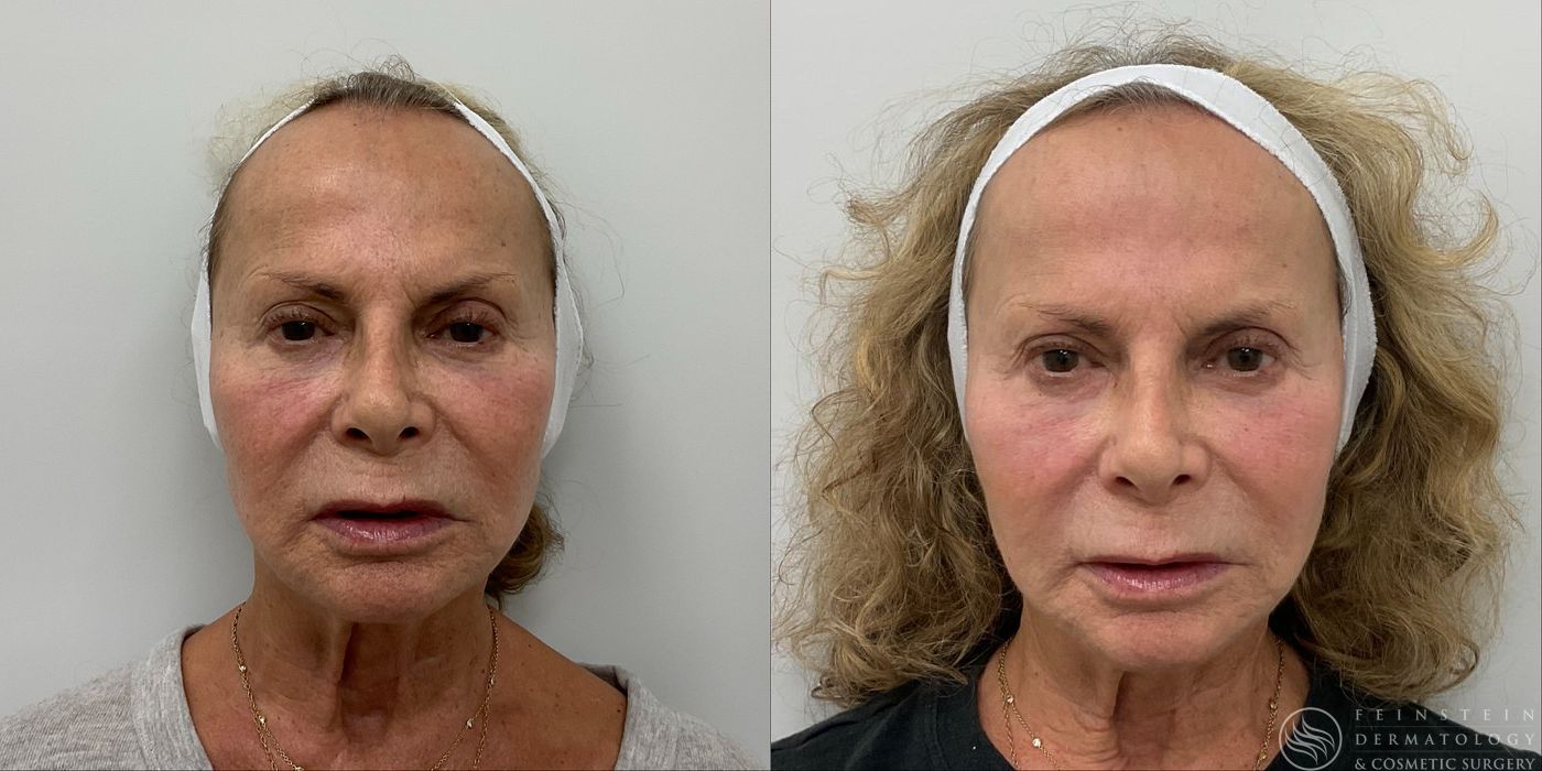 Forever Young® BBL - Case 12311