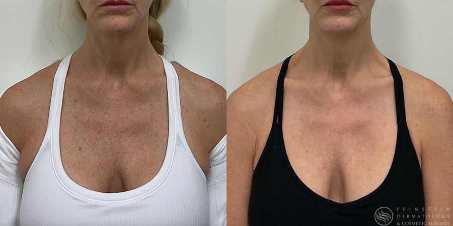 Forever Young® BBL - Case 12324