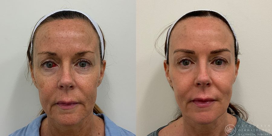 Forever Young® BBL + HALO® Laser - Case 12335