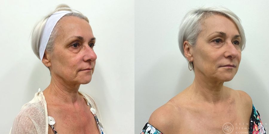 Forever Young® BBL + HALO® Laser - Case 12331