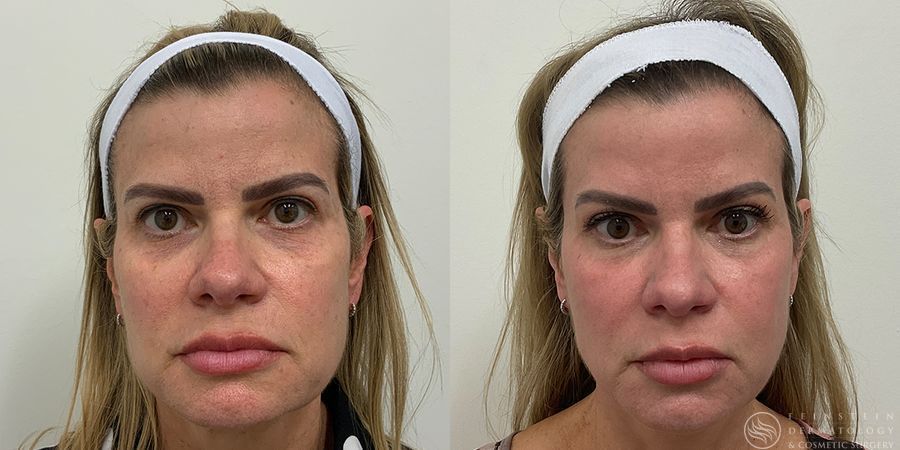 Forever Young® BBL + HALO® Laser - Case 12329