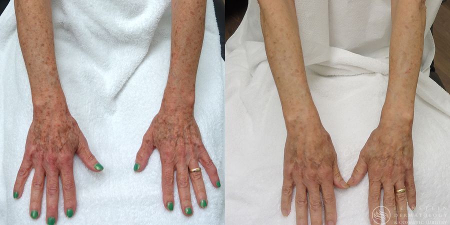 Forever Young® BBL + HALO® Laser - Case 12336