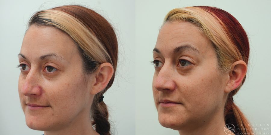 Forever Young® BBL + HALO® Laser - Thumbnail 2