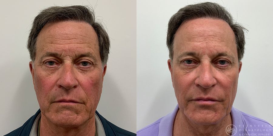 Forever Young® BBL + HALO® Laser - Case 12334