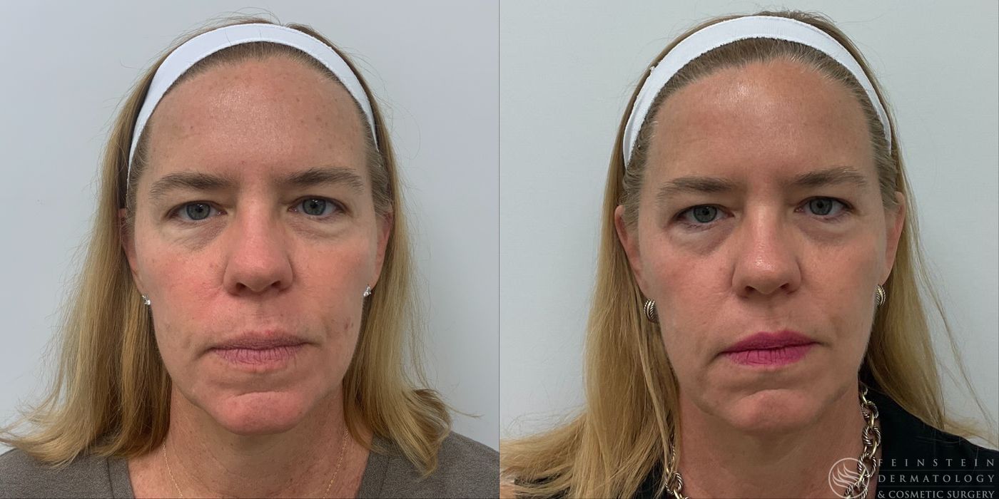 Forever Young® BBL + HALO® Laser - Case 12327